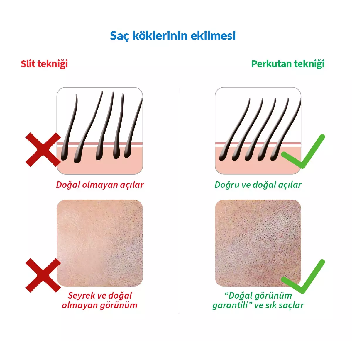 Saç Ekiminde Perkutan Dönemi