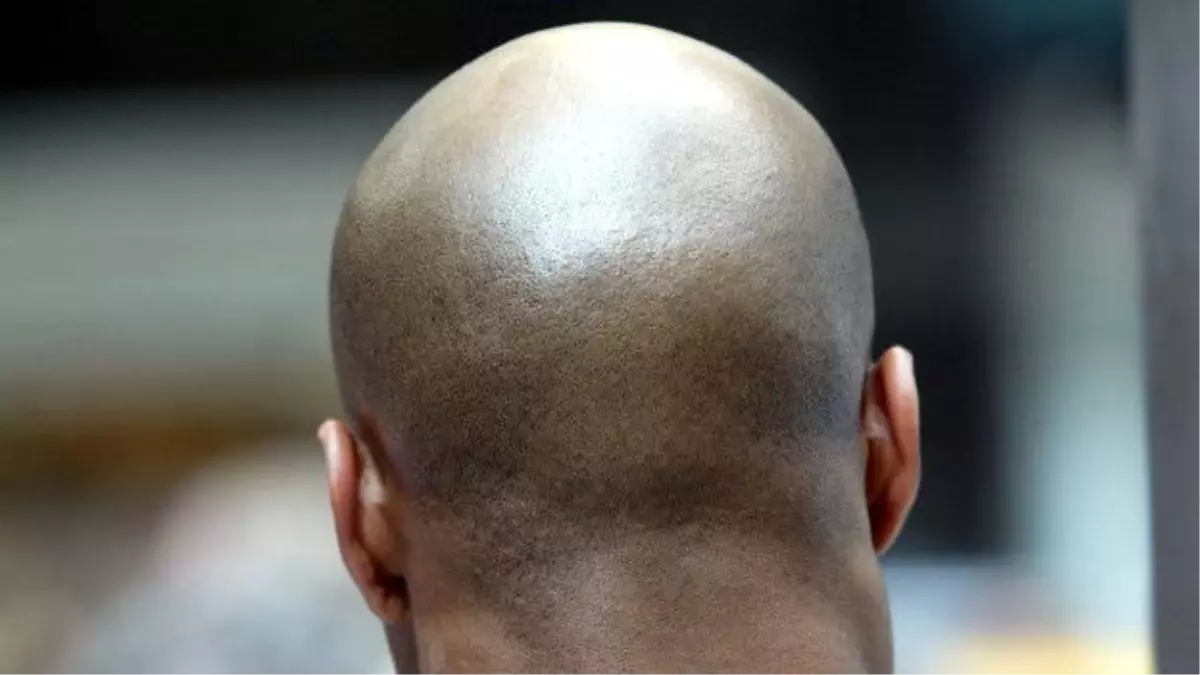 Saç Ekiminde Başarısız Sonucun Telafisi Yok"