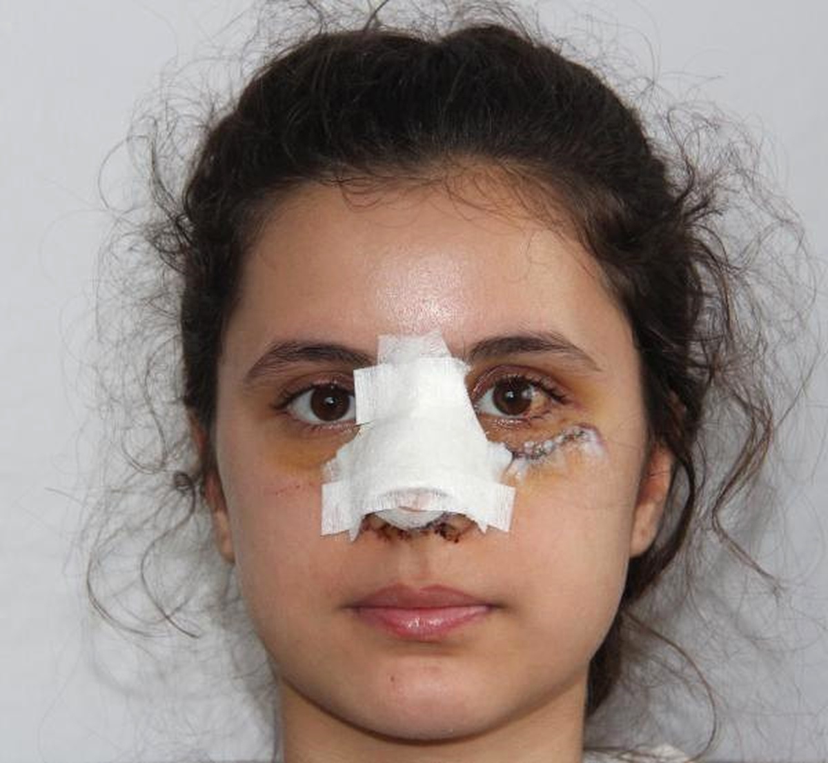 Uyuşturucu Bağımlısı, 13 Yaşındaki Kıza Sopayla Saldırıp Burnunu Kırdı