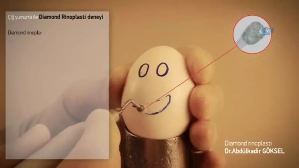 Alman ve Ruslar Burun Estetiği İçin Türkiye\'ye Akın Ediyor