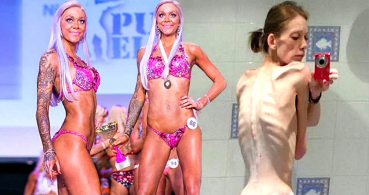 Anoreksi Hastalığıyla Ölümden Dönen Kadın Vücut Geliştirme Şampiyonu Oldu