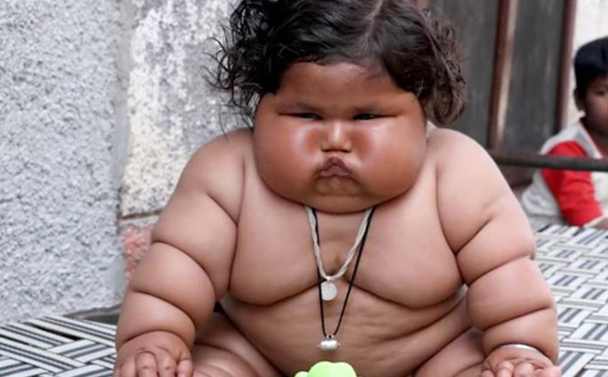 Hindistan\'da 8 Aylık Bebek 17 Kilo Ağırlında