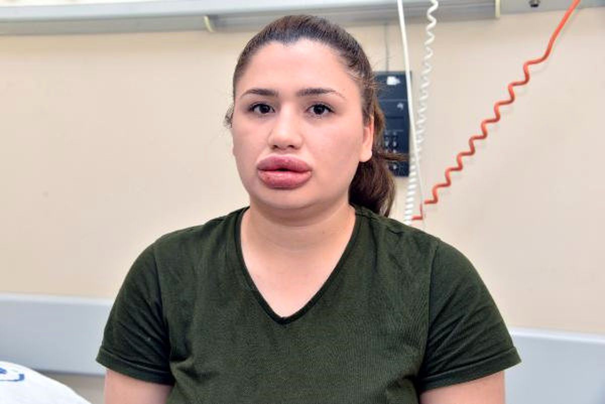 Kuaförün \'Doktor\' Olduğunu Söyleyerek Dolgu Yaptığı Dudakları Şişti