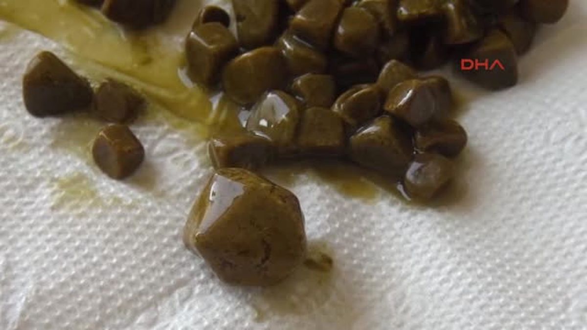 Edirne Safra Kesesinden 100 Taş Çıkartıldı