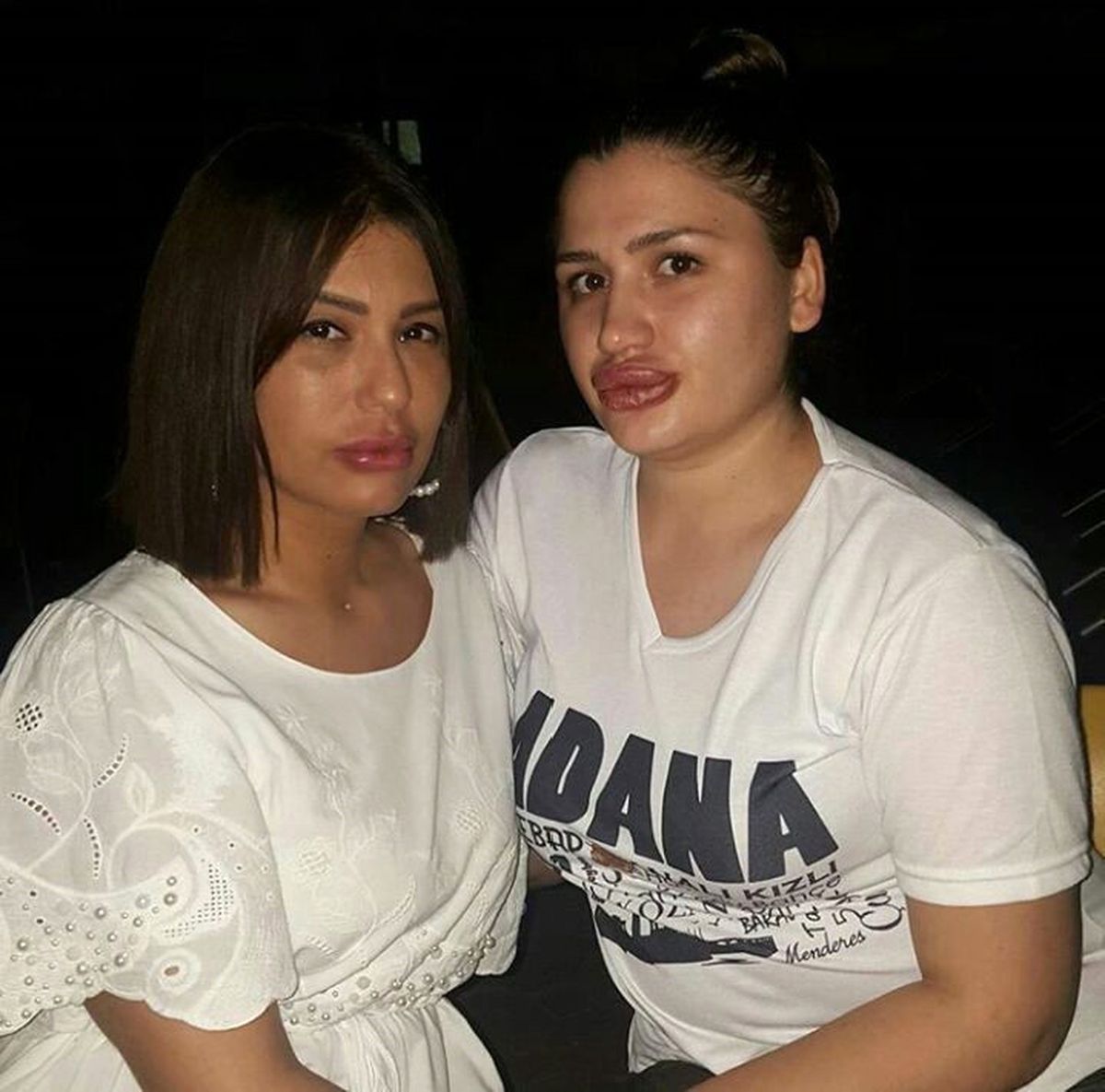 Estetik Dolgu Mağdurları Şikayetçi Oldu