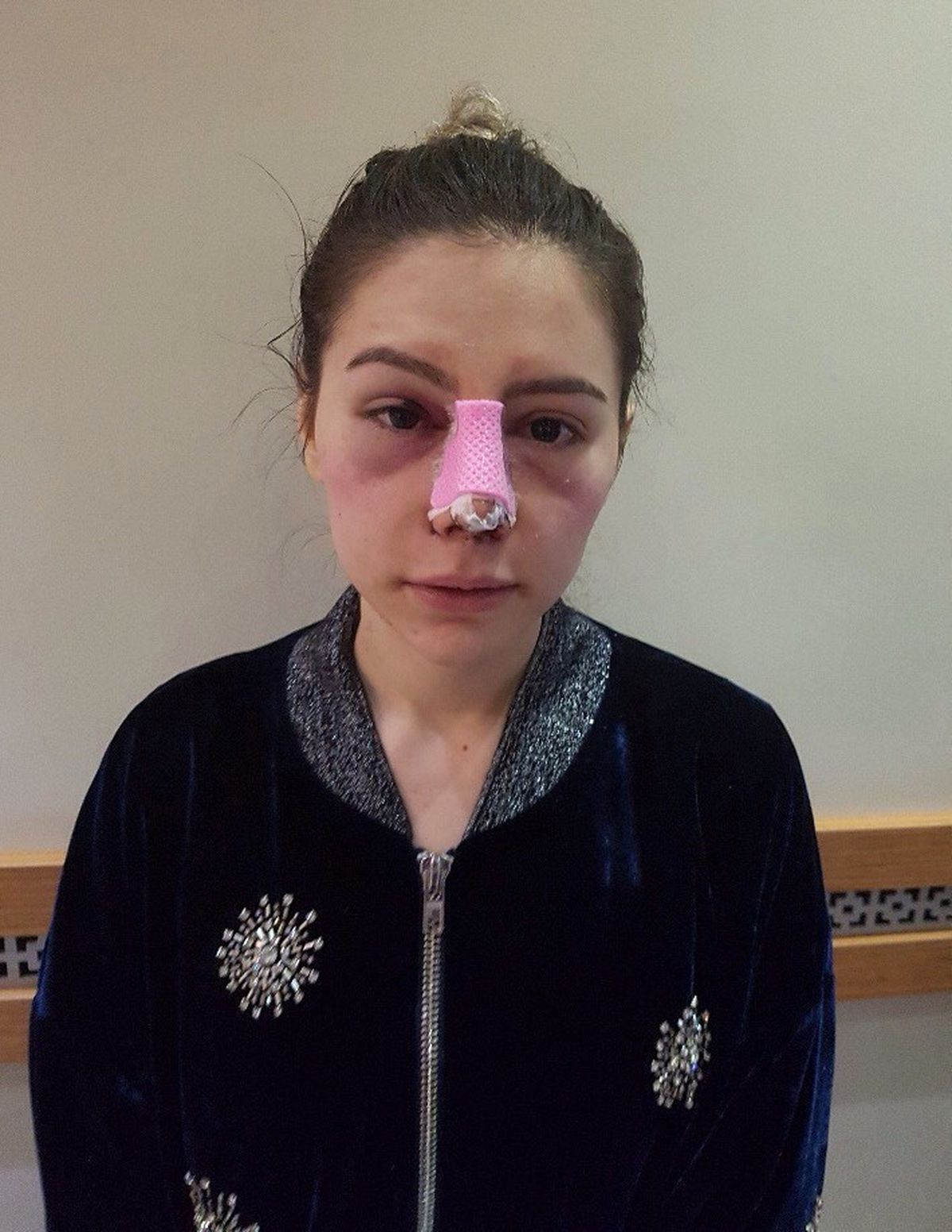 Çaldığı Paralarla Burnuna Estetik Yaptırdı