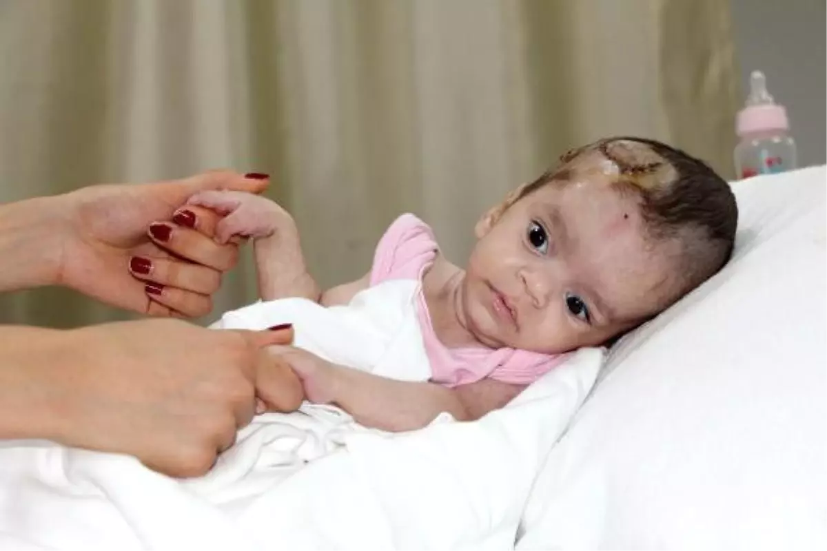 Mezarlığa Bırakılan 2 Beyin Ameliyatı Olan \'Kader\' Bebek, Yaşama Tutundu