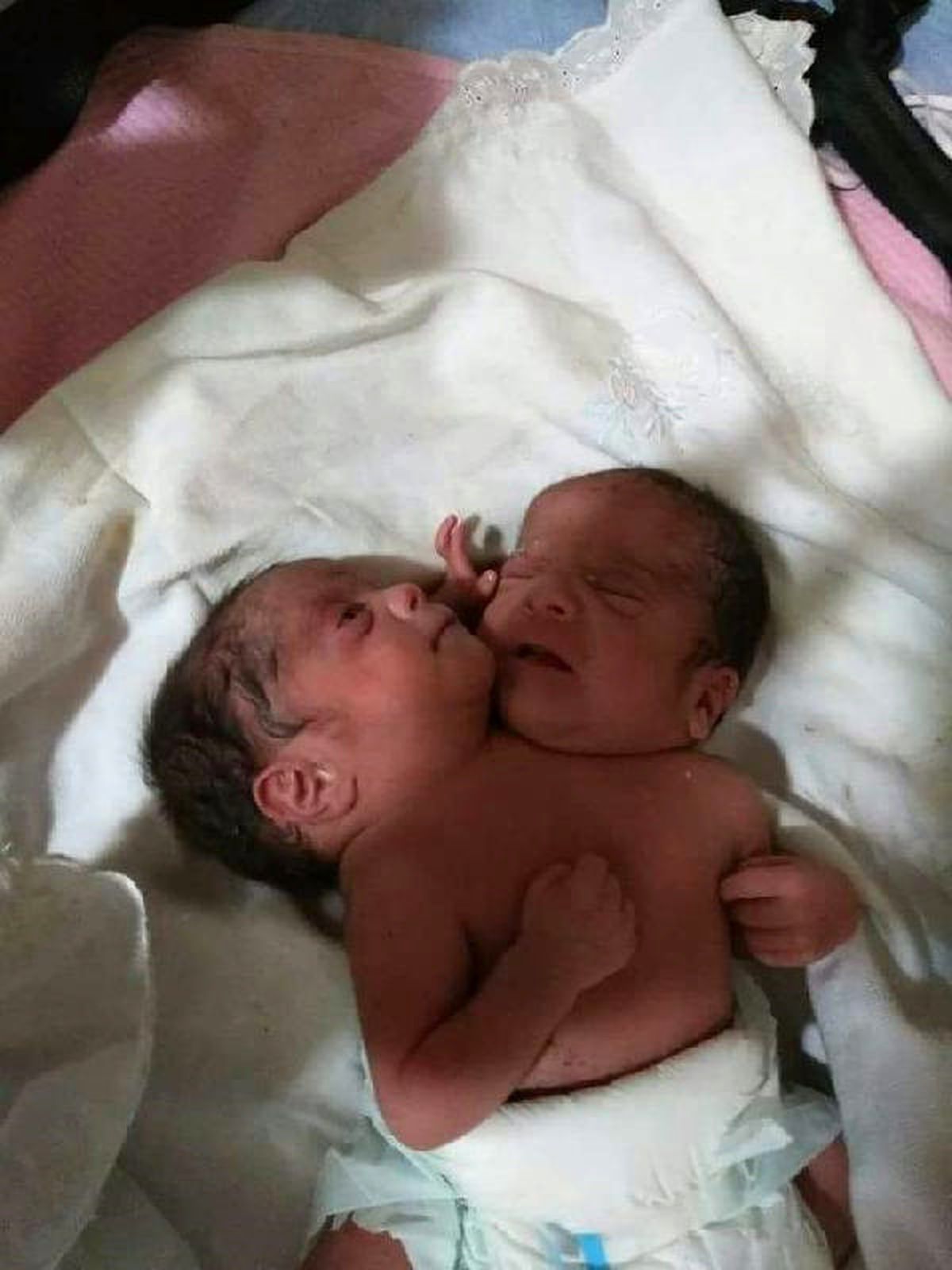 Çift Başlı Bebek Tedavi Altında
