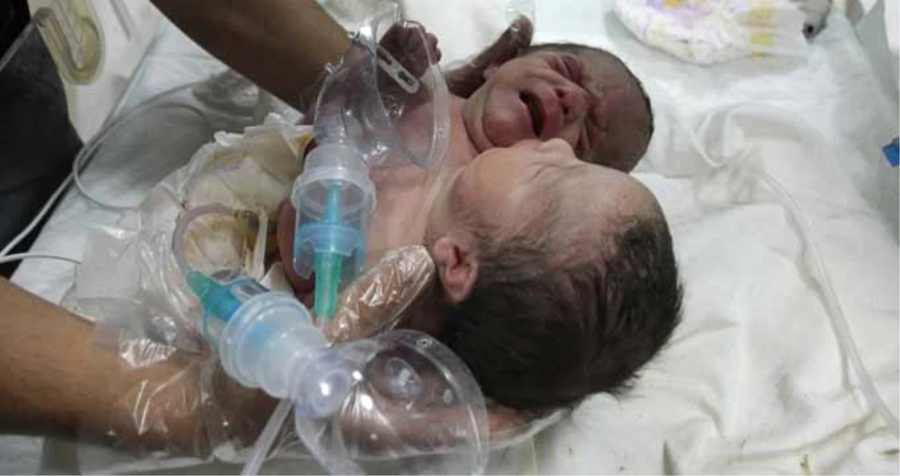 Suriye\'de Doğan Çift Başlı Bebek, Türkiye\'ye Getirildi