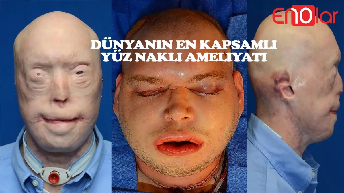 En Kapsamlı Yüz Nakli Yapılan Patrick'in 10 Madde ile Ameliyat Aşaması