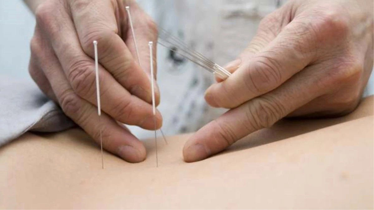 Hastanede Akupunktur ve Hacamatla Tedavi