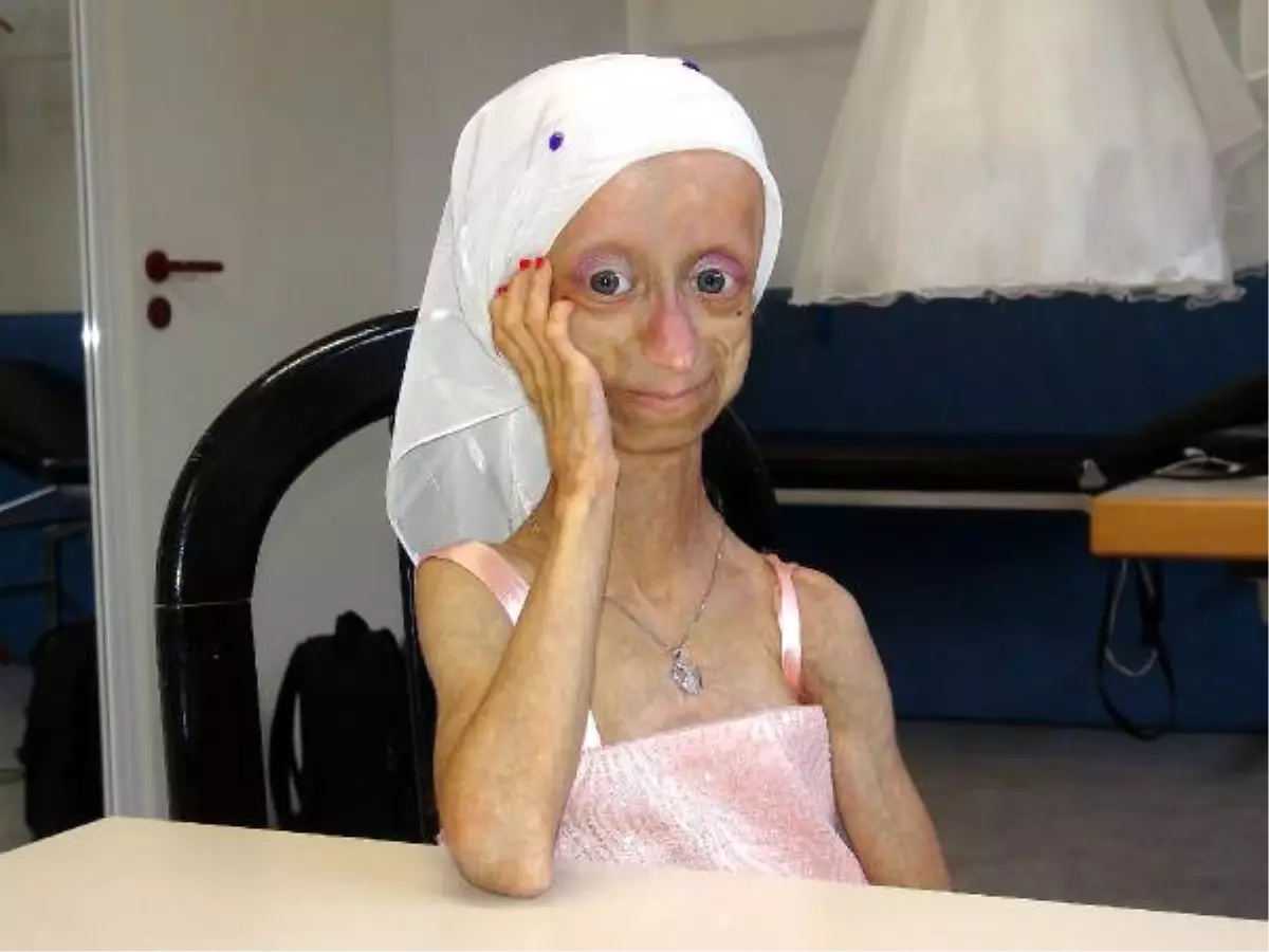 Milyonlar Yasta! Yaşlanma Hastası 17 Yaşındaki Gamze, Hayatını Kaybetti