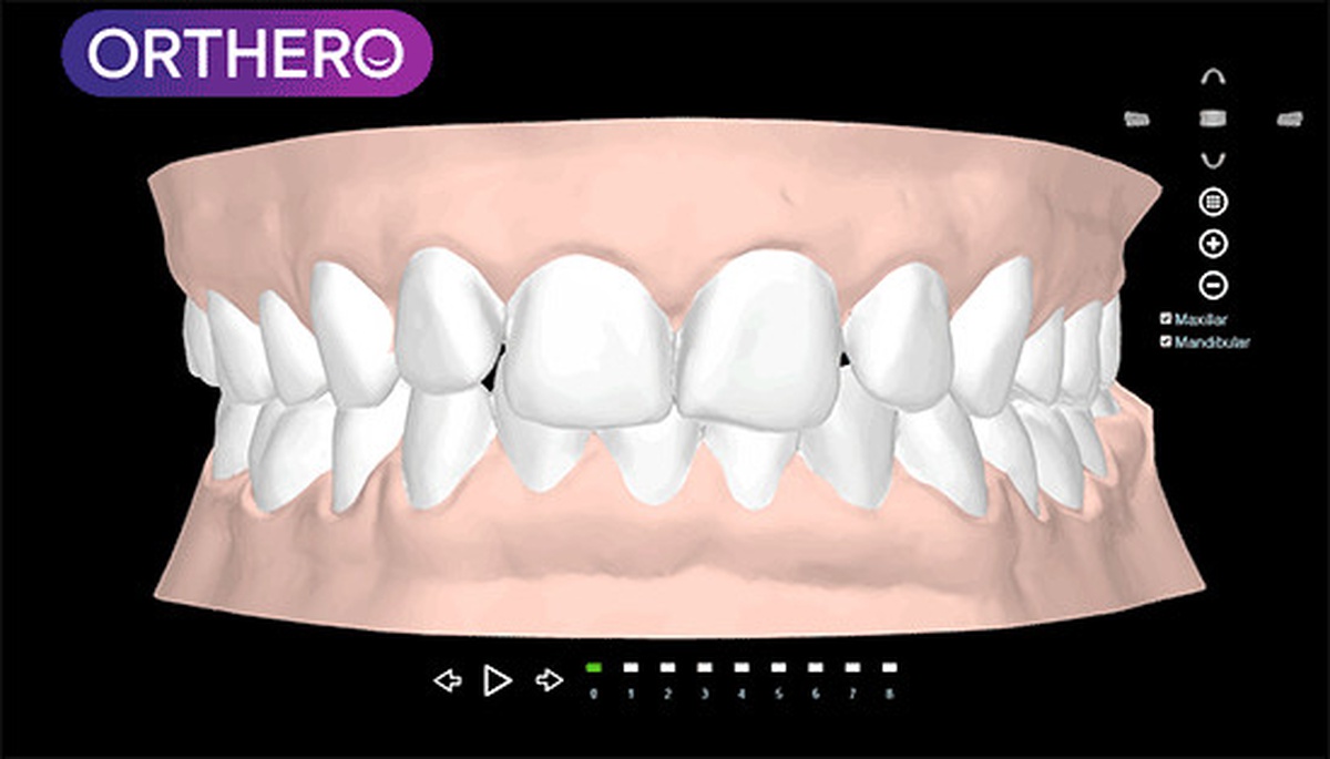 Şeffaf Aparey Orthero, Türkiye\'de 3d Yazıcı ile Üretilen İlk ve Tek