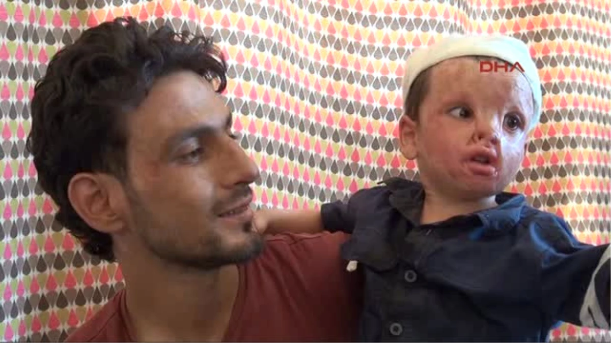 Hatay Suriyeli Baba, Yanan Oğlu Bara\'ya Estetik Ameliyat Istiyor