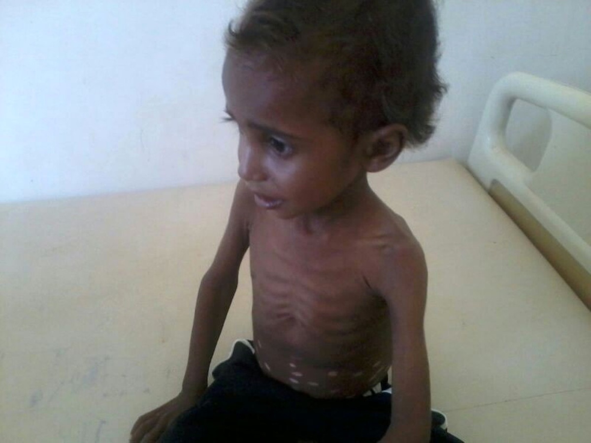 Yemenli Çocukların Yüzde 80\'i Insanı Yardıma Muhtaç