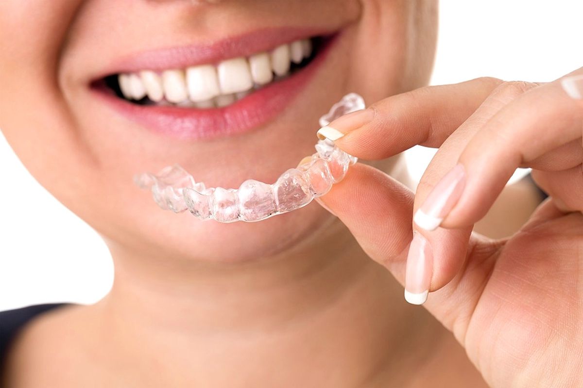Invisalign Tedavisiyle İlgili Bilinmesi Gereken 12 Nokta