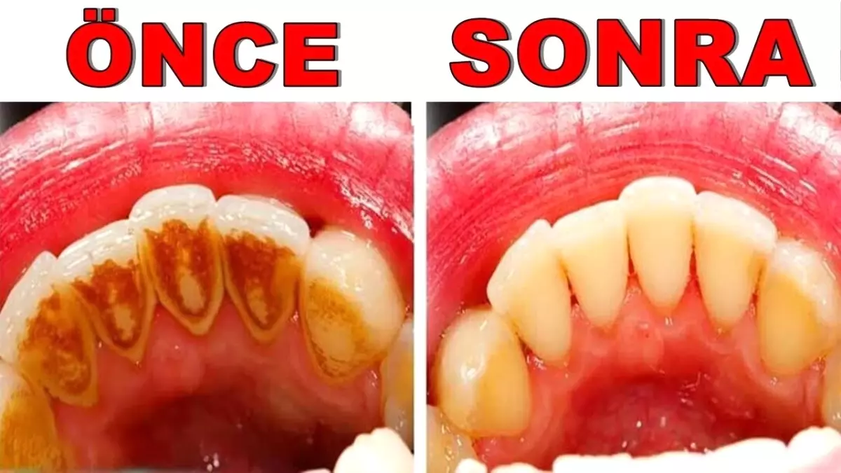 Dişçiye Gitmeden 3 Günde Evde Tartar Temizleme. Harika Yöntem!