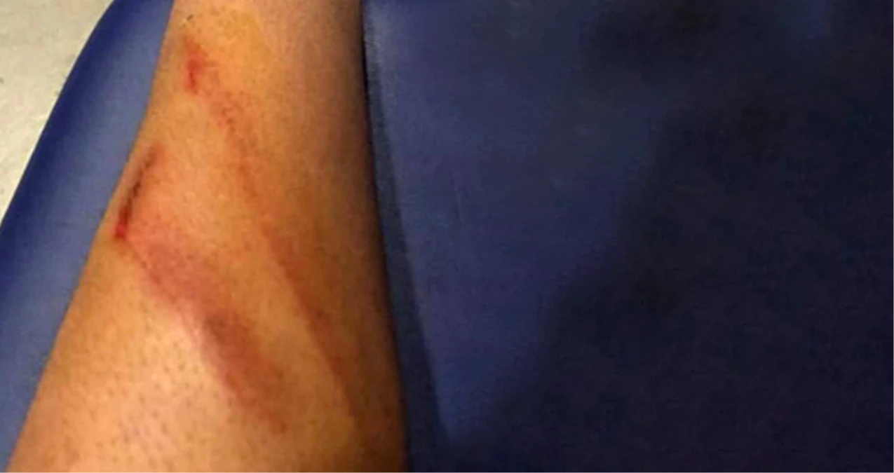 Malatyasporlu Futbolcu, Maçın Hakemine Bacağının Fotoğrafıyla Çattı