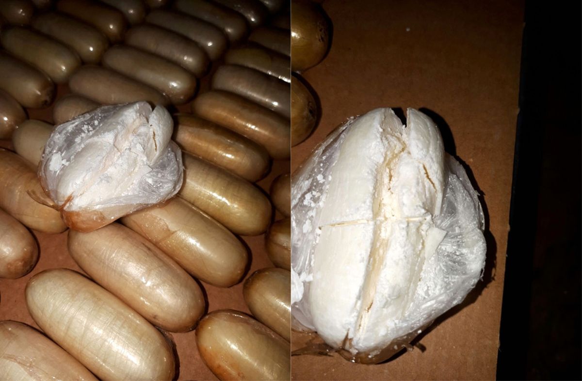 Midesinden 2 Kilo Uyuşturucu Çıktı