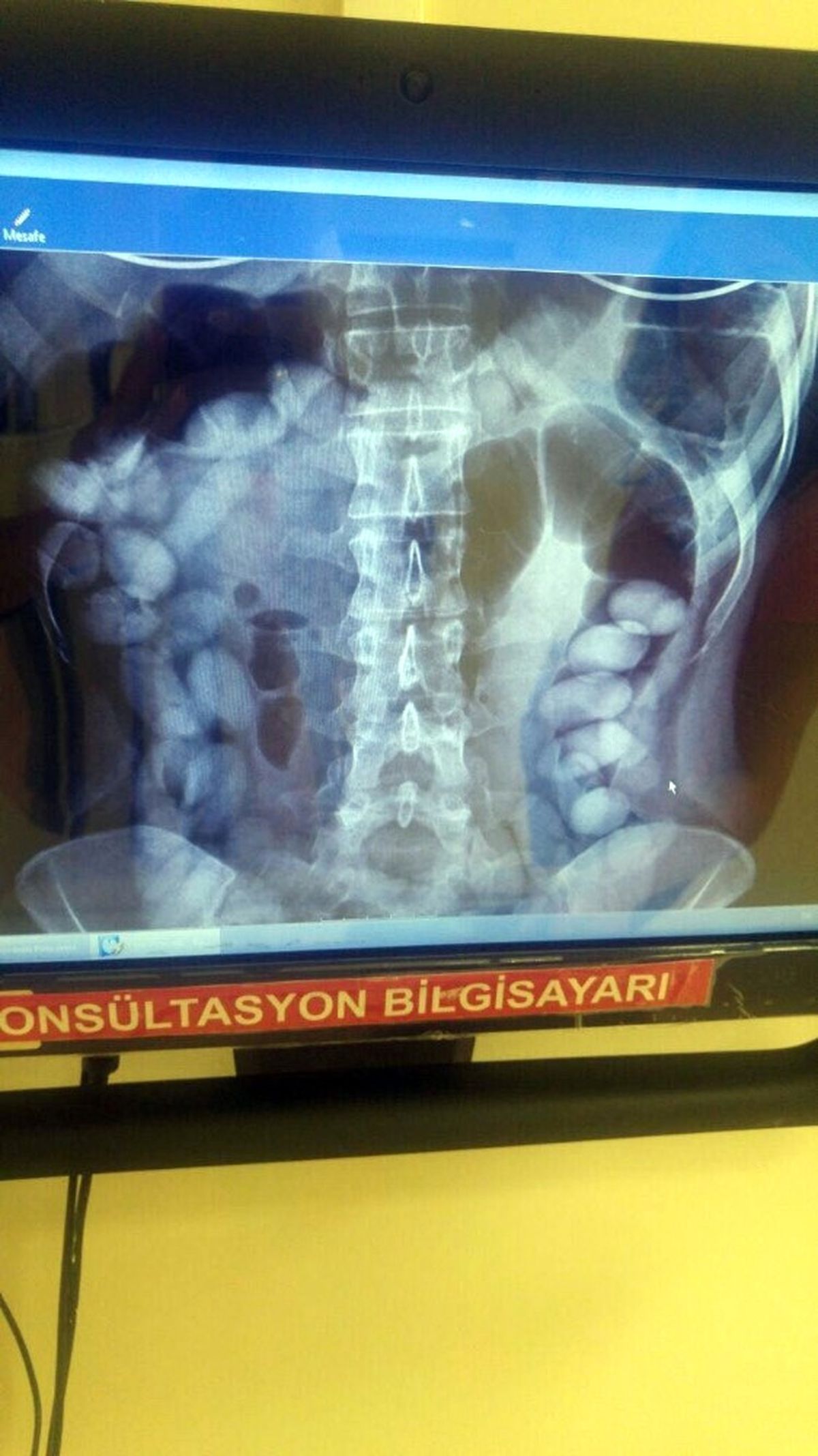 İç Organlarında 78 Adet Kokain Kapsülüyle Yakalandı