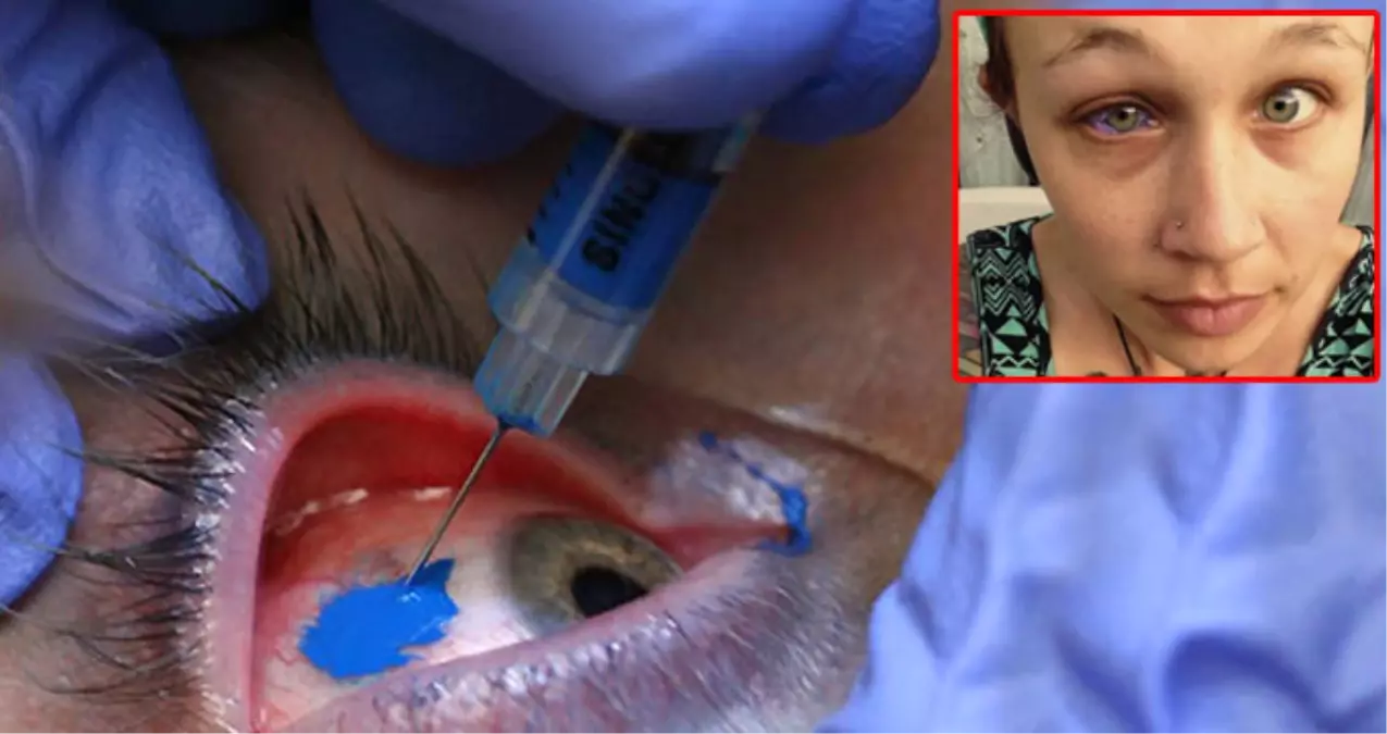 Gözünün Akına Dövme Yaptırmaya Gitti, Kısmen Kör Olarak Çıktı