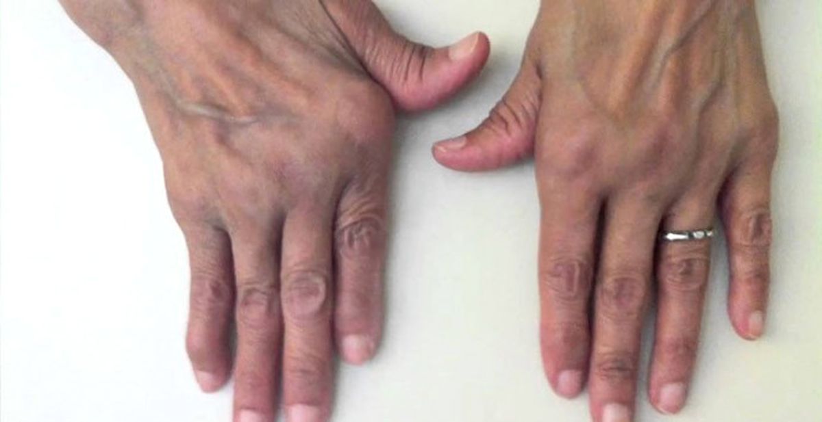 Romatoid Artrit Tedavisinde Kullanılan İlaç Türkiye\'de Üretilecek