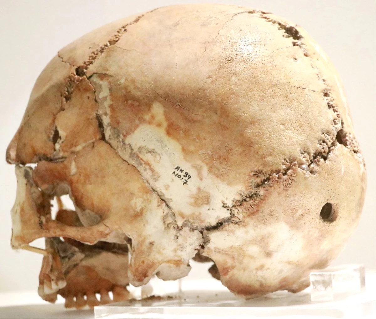 11 Bin Yıl Önce İlk Beyin Ameliyatının Yapıldığı Aşıklıhöyük Tarihe Işık Tutuyor