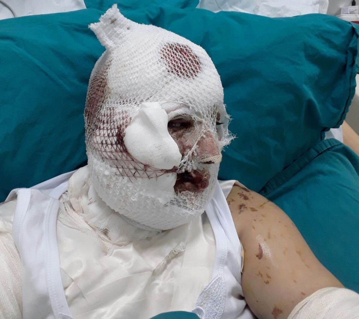 Tecavüze Karşı Koydu, Kezzapla Yakıldı