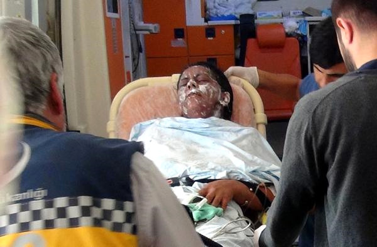 Mutfakta Düdüklü Tencerenin Patlamasıyla Yaralandı