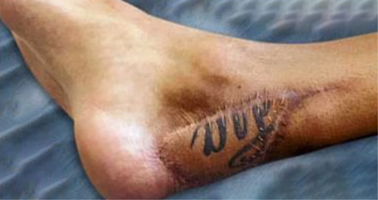 Yıldız Futbolcu Santi Cazorla\'nın Ayağının Son Hali İçler Acısı