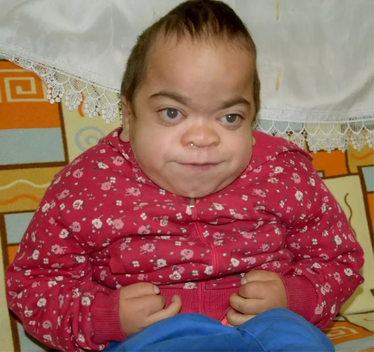 Mps Hastası Küçük Kız Hayatını Kaybetti