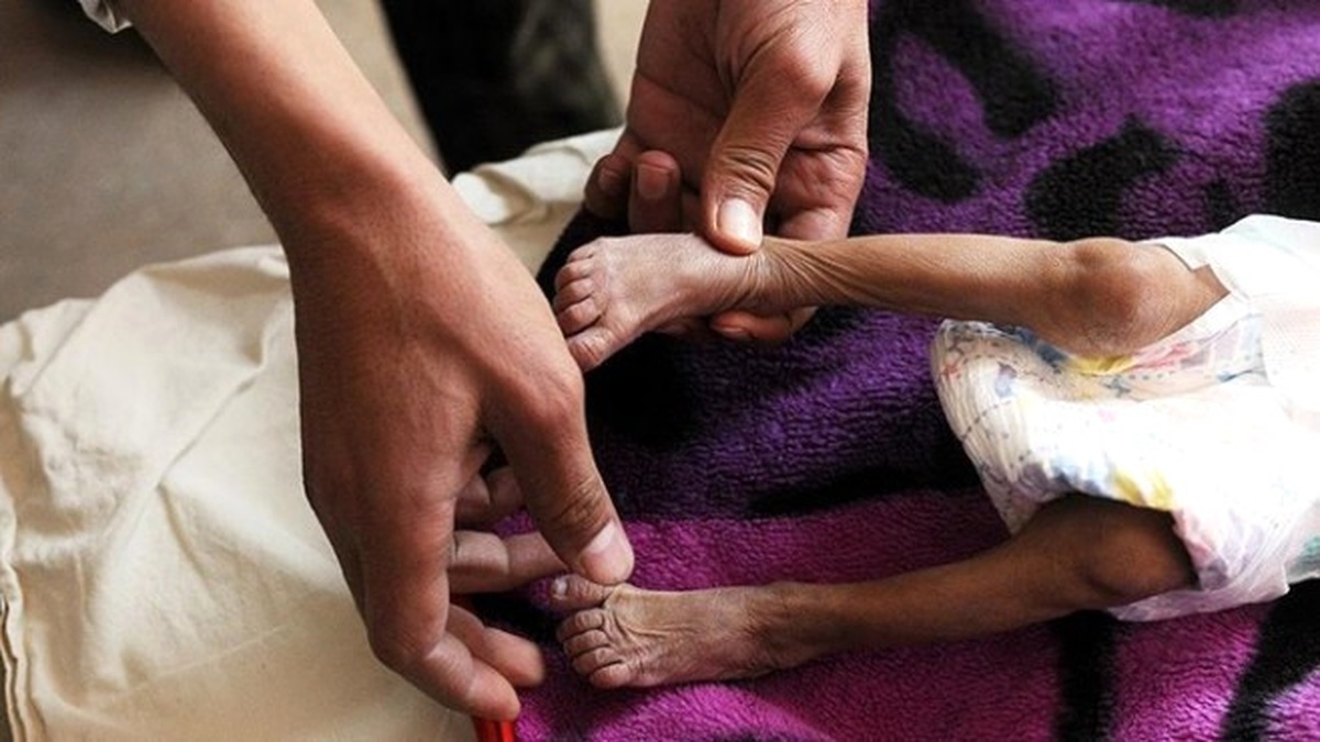 Yemen\'deki Difteri Salgınında Ölenlerin Sayısı 34\'e Yükseldi