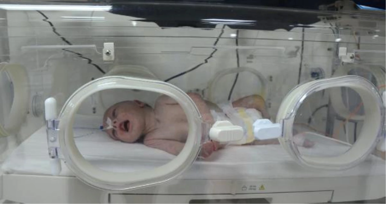 5 Günlük Bebeğin Bağırsaklarından 1 Kilo 300 Gram Kitle Çıkarıldı
