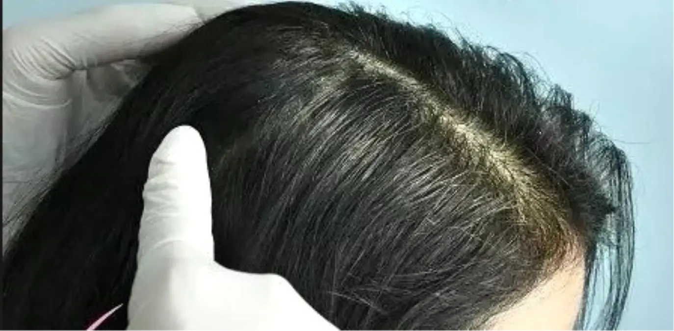 Saç Ekimine Erkeklerden Çok Kadınlar da Merak Saldı