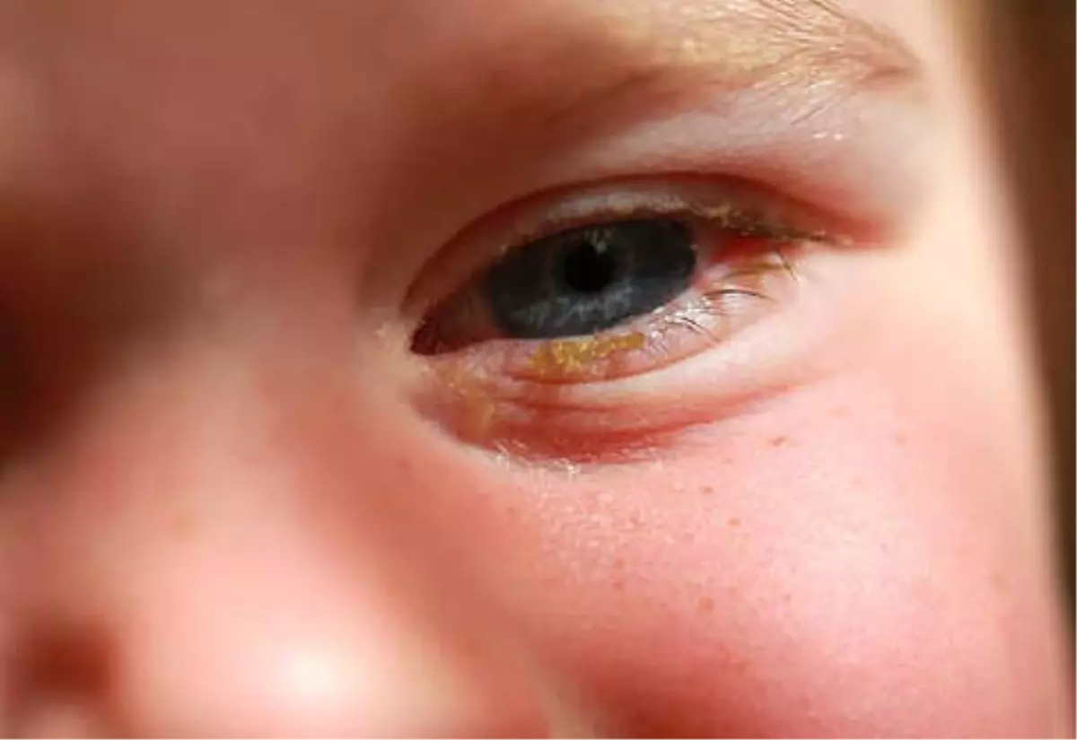Çocuklarda Göz Çapaklanması Neden Olur?