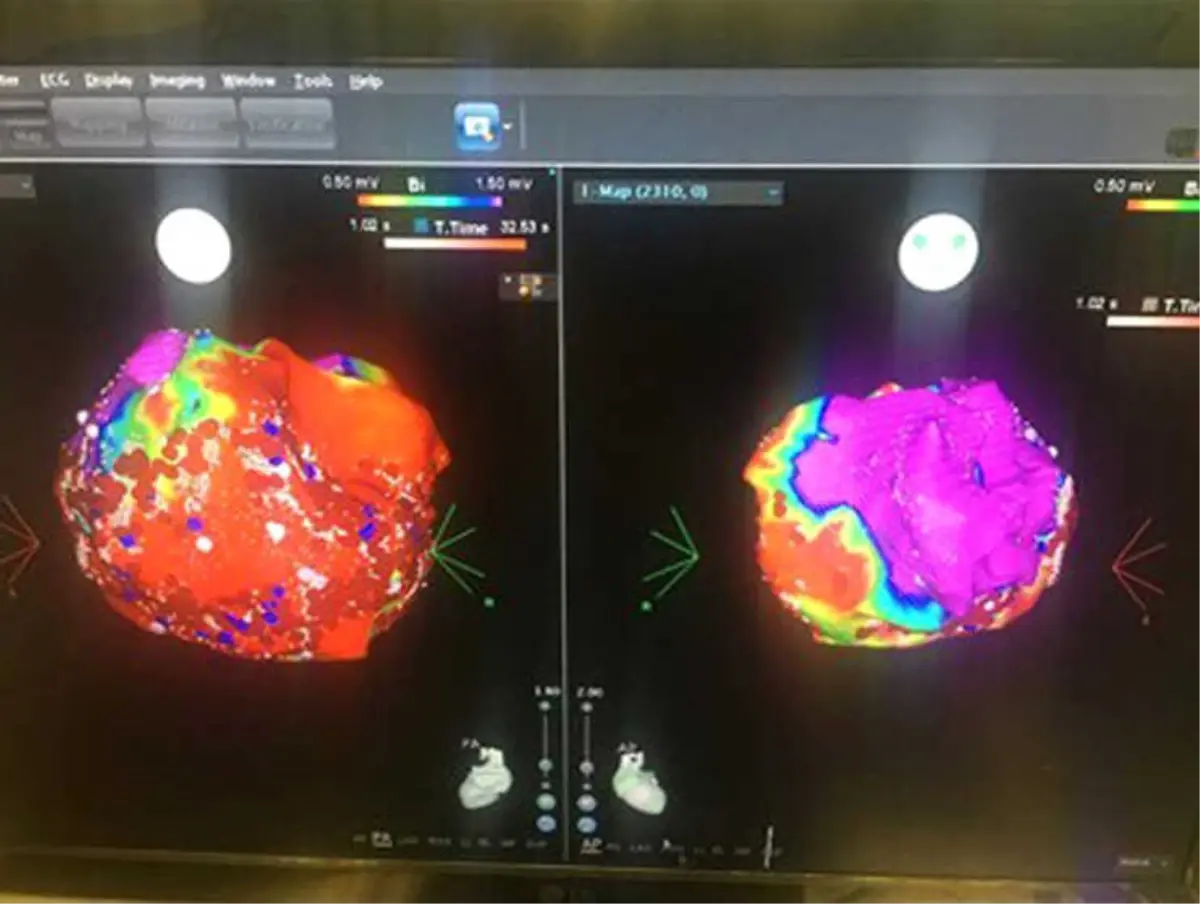 Kalp Ritim Bozukluklarında Yaşam Boyu İlaç Kullanımına Son