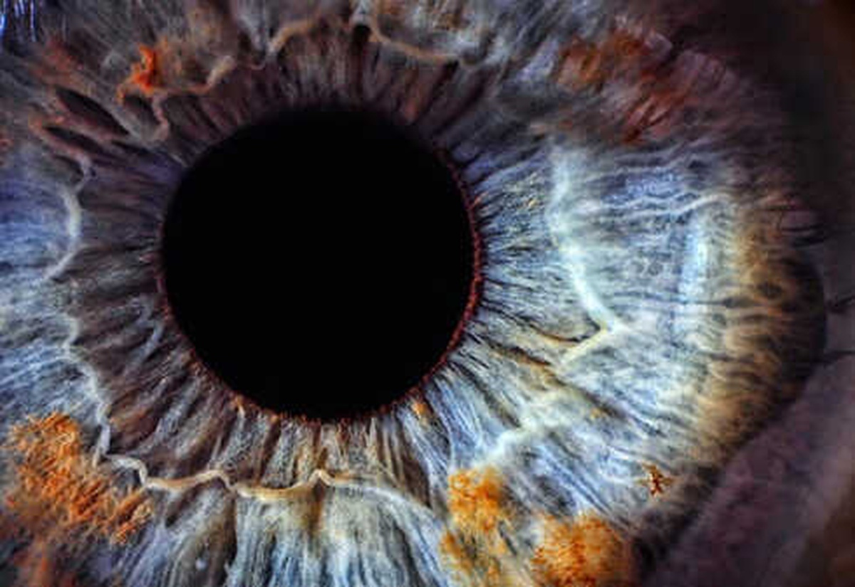 Sarı Nokta Hastalığı Olanlar Nasıl Beslenmeli?