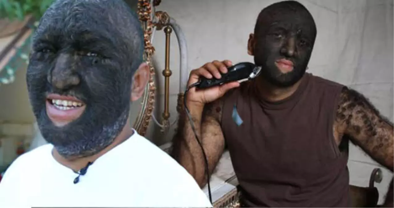 Suratının Yüzde 98\'i Kıllarla Kaplı! Dünyanın En Kıllı İnsanı Artık Çok Mutlu