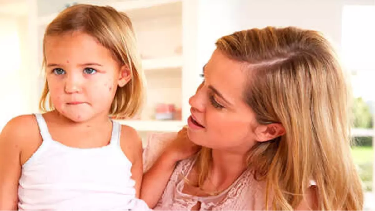 Kızamık Nedir? Kızamık Nasıl Bulaşır ve Belirtileri Nelerdir?