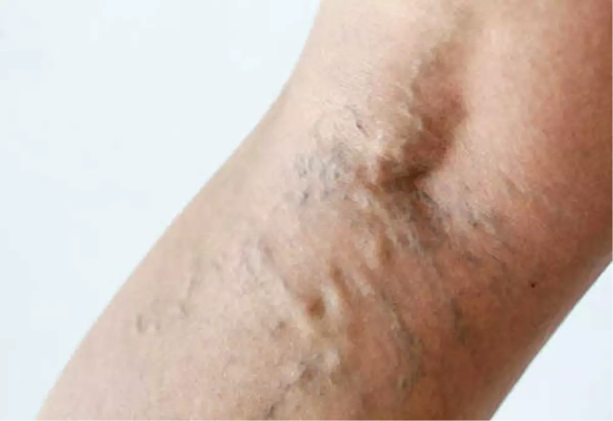 Evta Yöntemi Nedir, Nasıl Uygulanır?