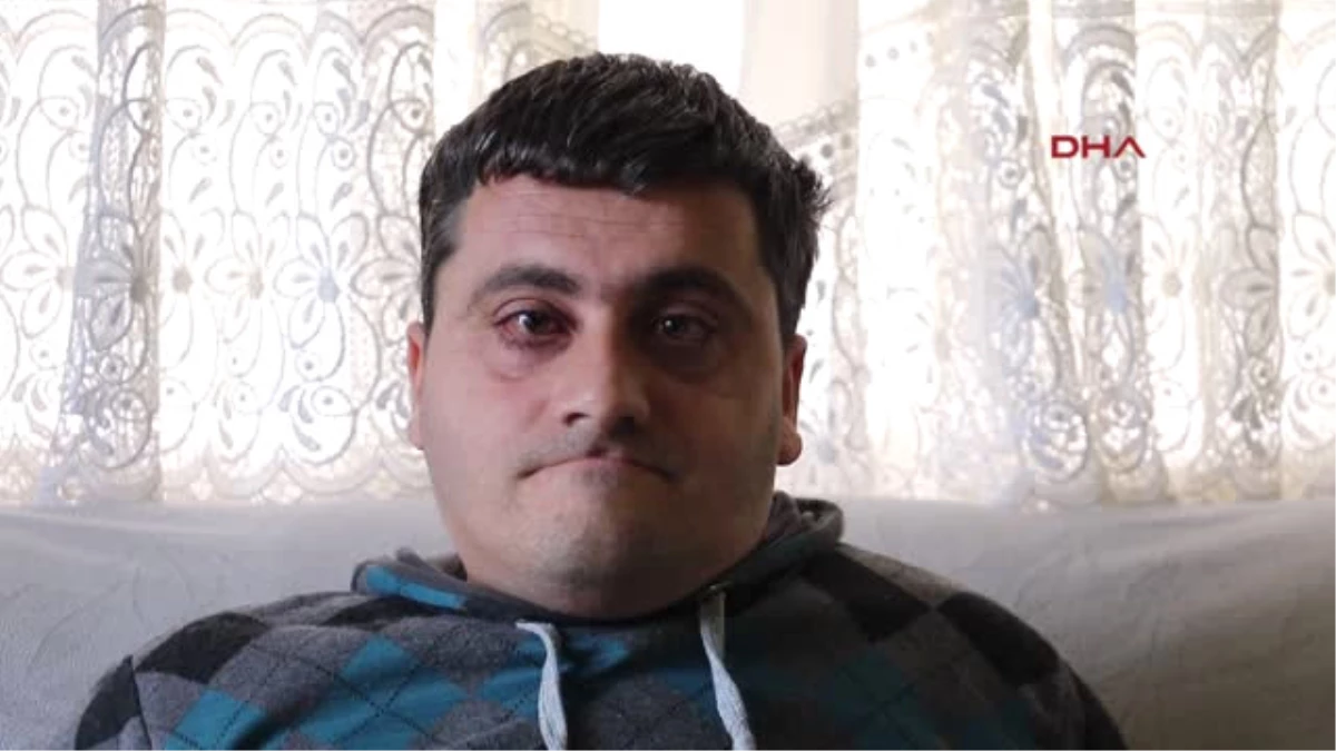 Samsun Cam Kemik Hastası Genç, 3 Yıldır Görme Kaybı Yaşıyor
