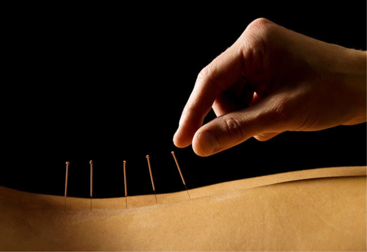 Akupunktur Nedir, Hangi Hastalıklara İyi Gelir?