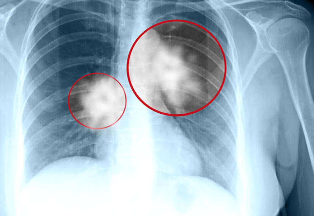 Sekonder Akciğer Kanserlerinde Cerrahi Mümkün