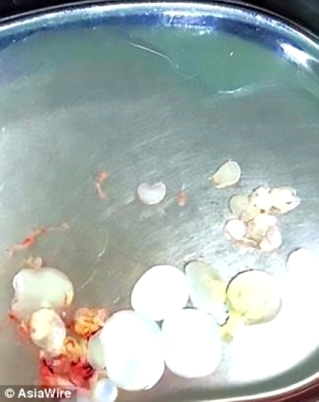 Az Pişmiş Domuz Eti Yiyen Adamın Beyninde 30 Tenya Yumurtası Bulundu