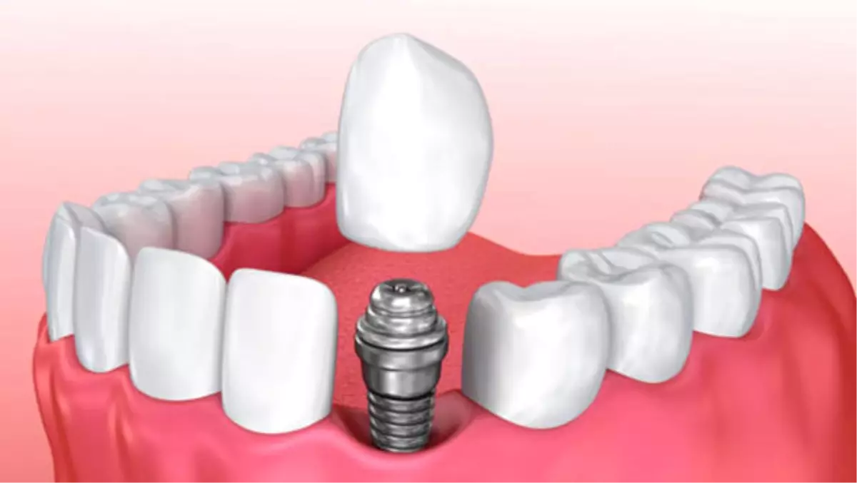 Dental İmplant Tedavisi Hakkında Merak Ettiğiniz Her Şey!