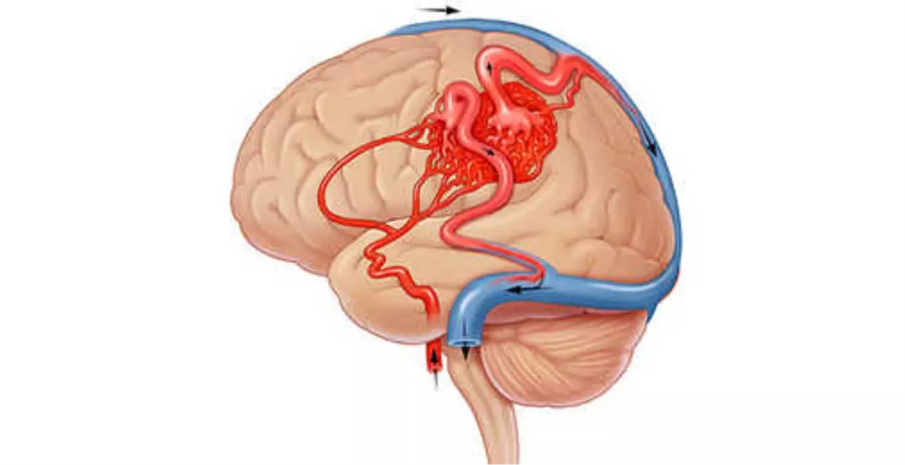 Avm (Damar Yumağı) Nedir? Tedavisi Nasıl Yapılır?
