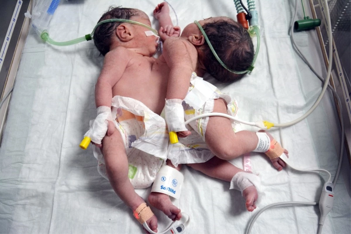 Konya\'da Doğan Yapışık İkizler Ameliyatla Ayrıldı, Biri Kurtarılamadı