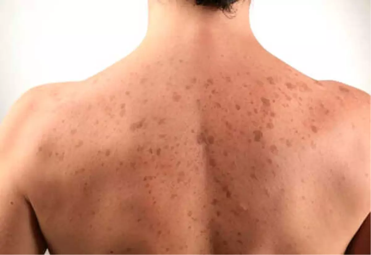 Sırttaki Lekeler Nasıl Geçer?