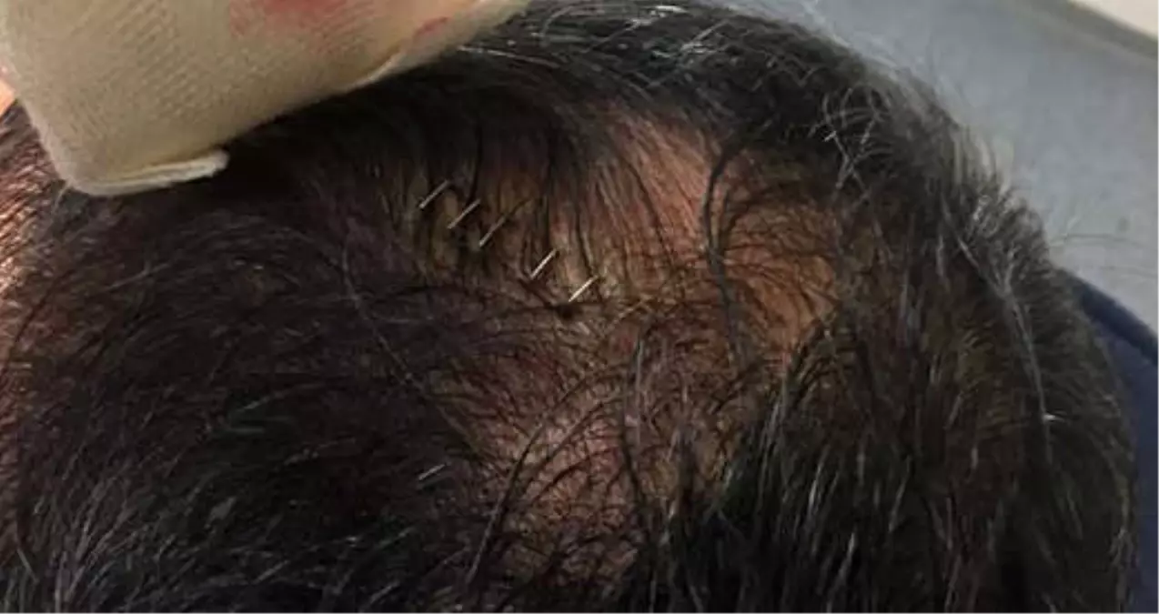 Başından Yaralanan Şenol Güneş, Hastaneden 7 Günlük Rapor Almış