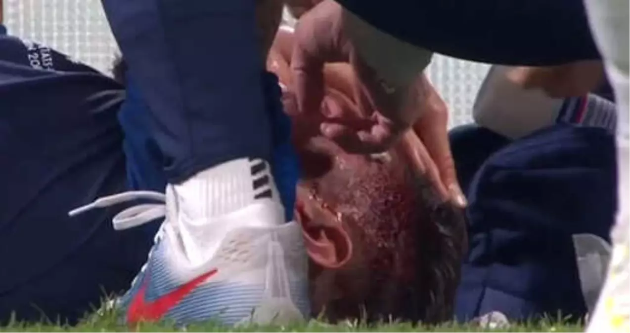 Fransa - ABD Maçında Giroud\'nun Kaşı Açıldı